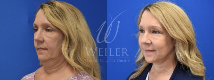 Before & After Facelift Case 828 Right Oblique View in Baton Rouge, Louisiana