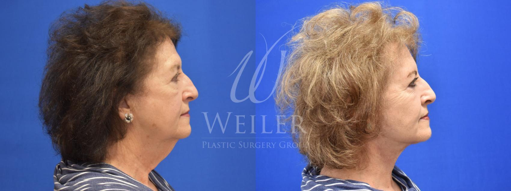 Before & After Facelift Case 864 Right Side View in Baton Rouge, New Orleans, & Lafayette, Louisiana