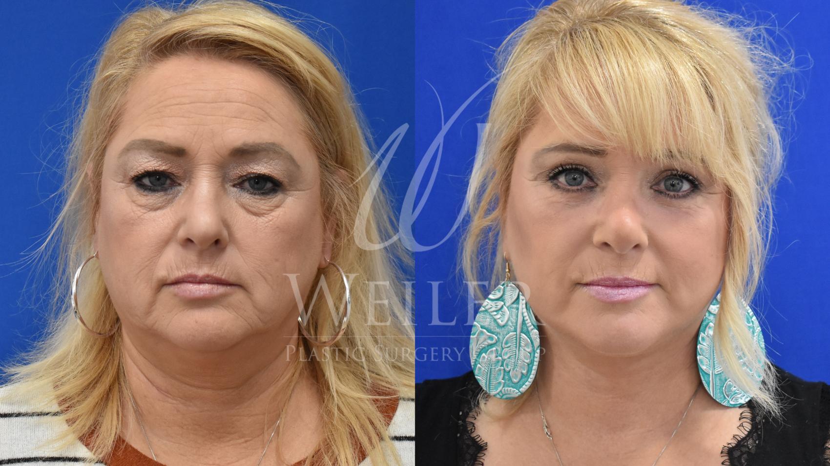 Before & After Facelift Case 870 Front View in Baton Rouge, Louisiana