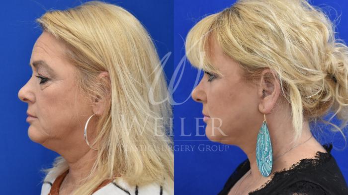 Before & After Facelift Case 870 Right Side View in Baton Rouge, Louisiana