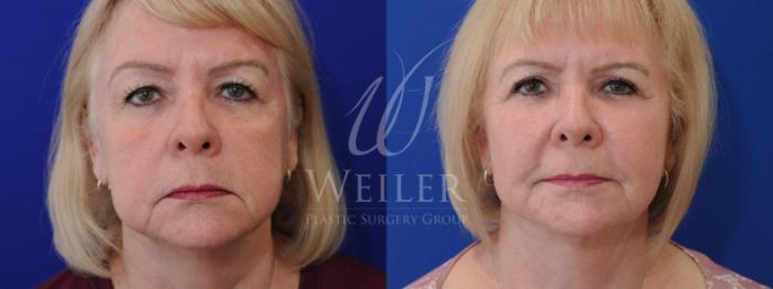 Before & After Facelift Case 871 Front View in Baton Rouge, New Orleans, & Lafayette, Louisiana