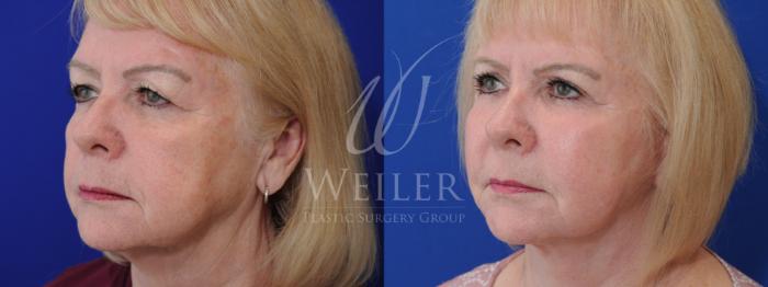 Before & After Facelift Case 871 Left Oblique View in Baton Rouge, New Orleans, & Lafayette, Louisiana