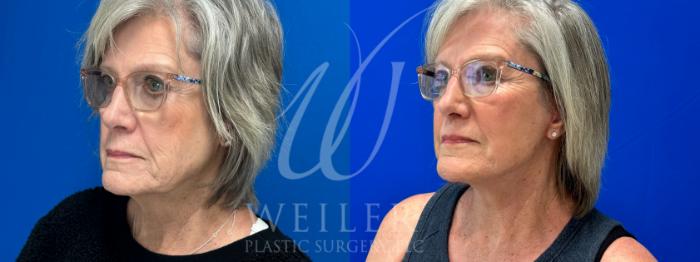 Before & After Facelift Case 991 Left Side View in Baton Rouge, Louisiana