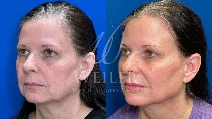 Before & After Facial Balancing Case 1453 Left Side View in Baton Rouge, New Orleans, & Lafayette, Louisiana