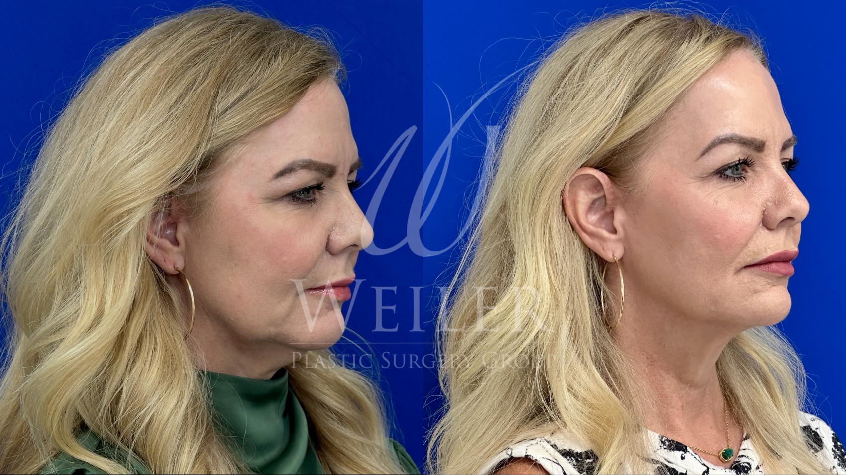 Before & After JUVÉDERM® Case 1504 Right Oblique View in Baton Rouge, New Orleans, & Lafayette, Louisiana