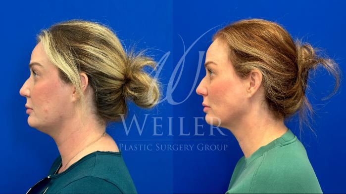 Before & After Restylane® Case 1505 Left Side View in Baton Rouge, New Orleans, & Lafayette, Louisiana