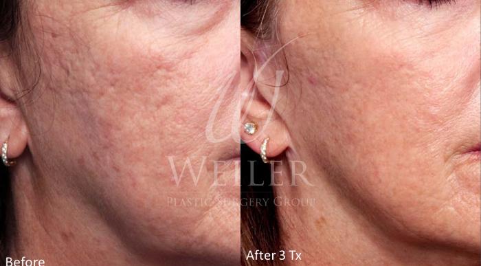 Before & After Genius® Microneedling with RF Case 390 View #1 View in Baton Rouge, Louisiana