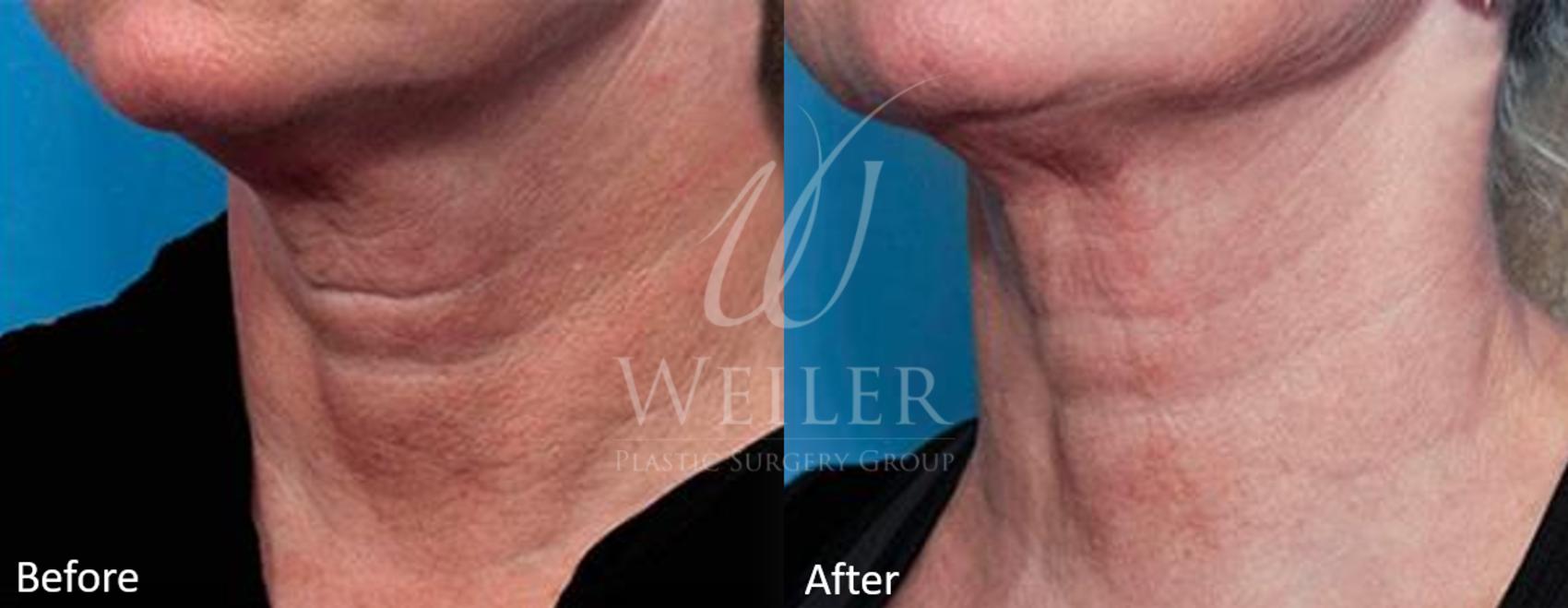 Before & After Genius® Microneedling with RF Case 391 View #1 View in Baton Rouge, Louisiana