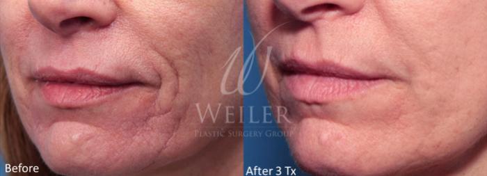 Before & After Genius® Microneedling with RF Case 392 View #1 View in Baton Rouge, Louisiana