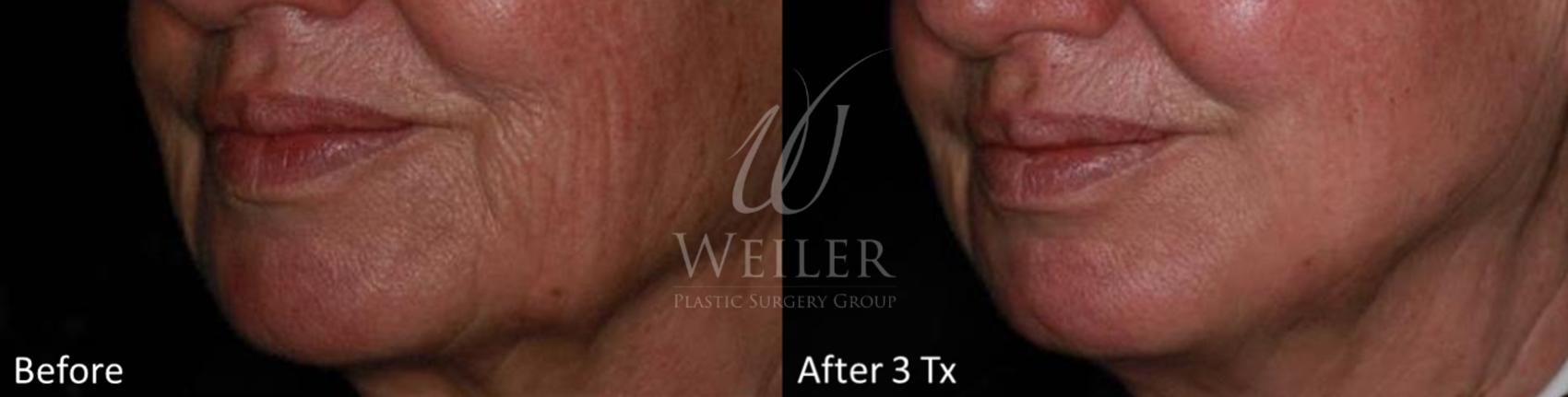 Before & After Genius® Microneedling with RF Case 393 View #1 View in Baton Rouge, Louisiana