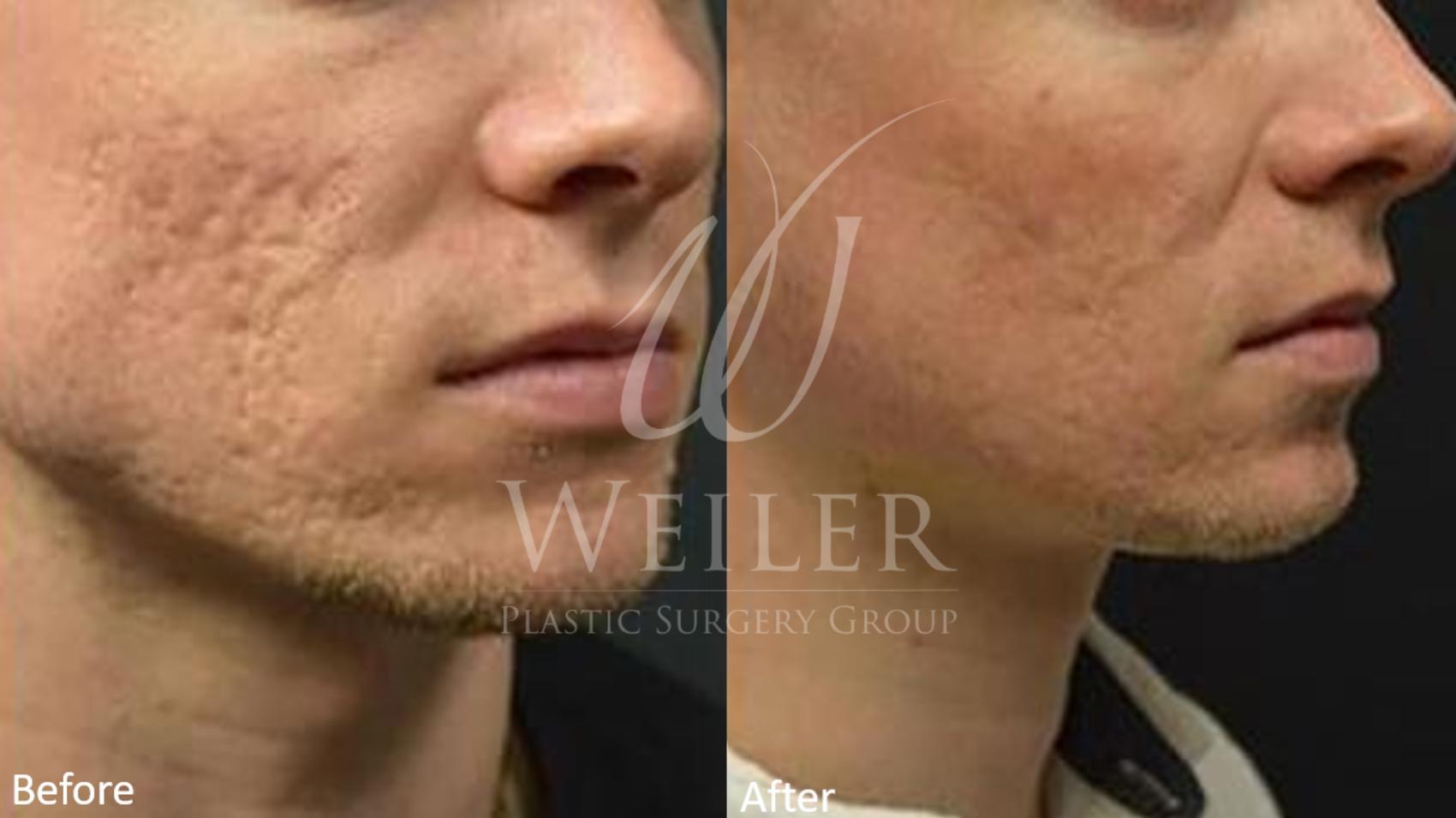 Before & After Genius® Microneedling with RF Case 394 View #1 View in Baton Rouge, Louisiana