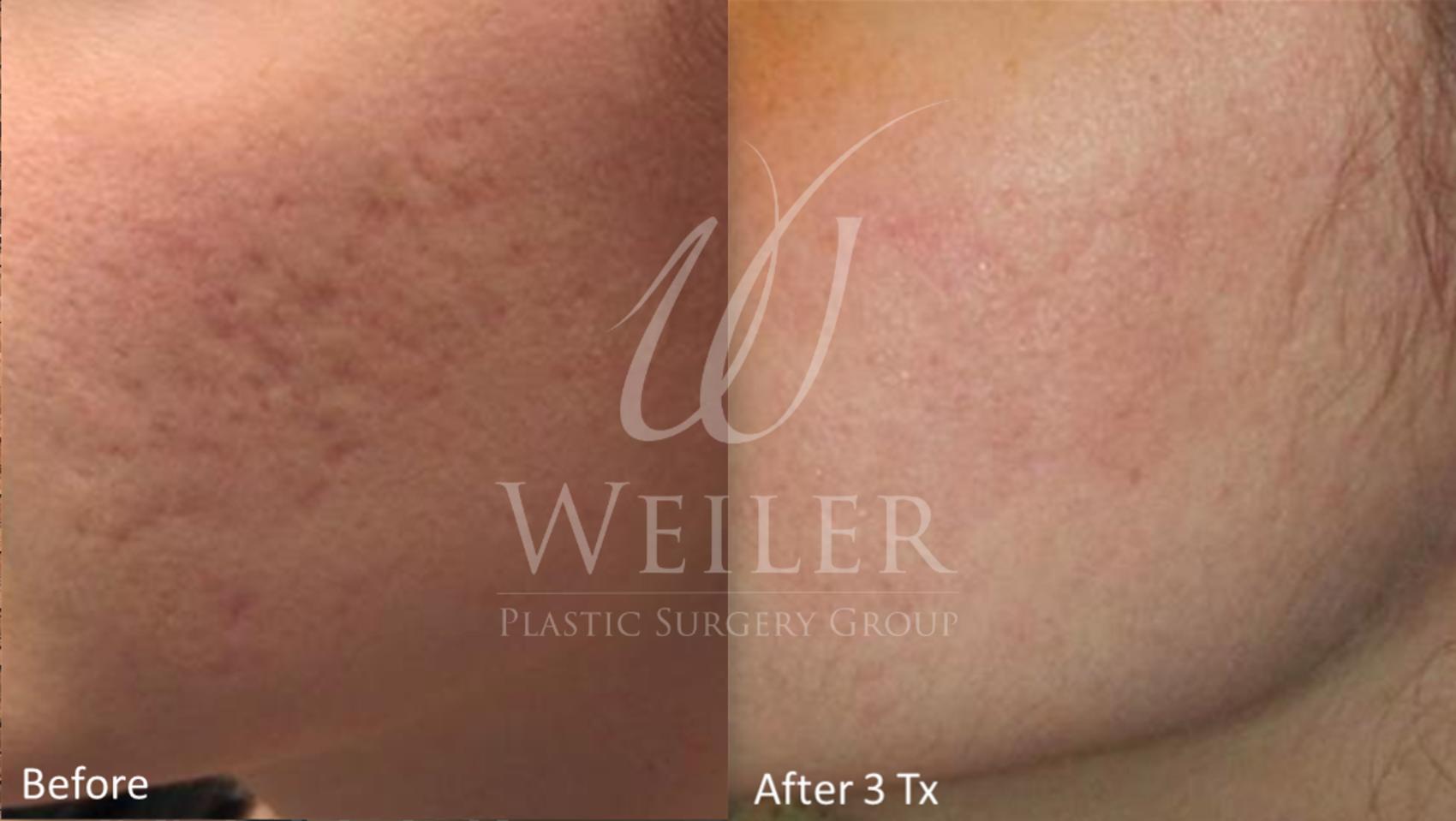 Before & After Genius® Microneedling with RF Case 395 View #1 View in Baton Rouge, Louisiana