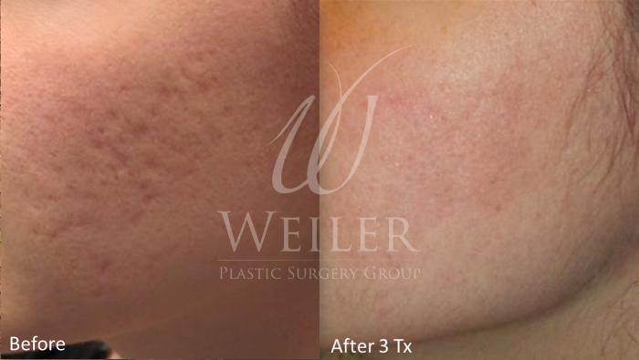 Before & After Genius® Microneedling with RF Case 395 View #1 View in Baton Rouge, New Orleans, & Lafayette, Louisiana