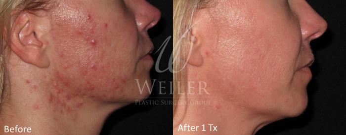 Before & After Genius® Microneedling with RF Case 398 View #1 View in Baton Rouge, Louisiana