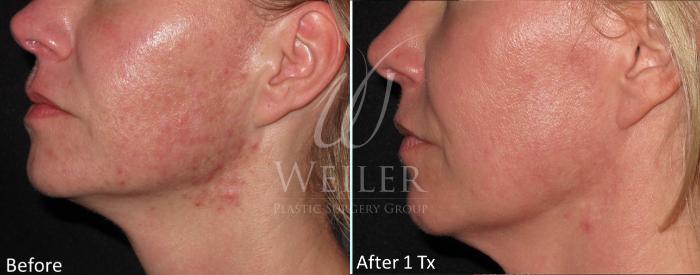 Before & After Genius® Microneedling with RF Case 399 View #1 View in Baton Rouge, New Orleans, & Lafayette, Louisiana