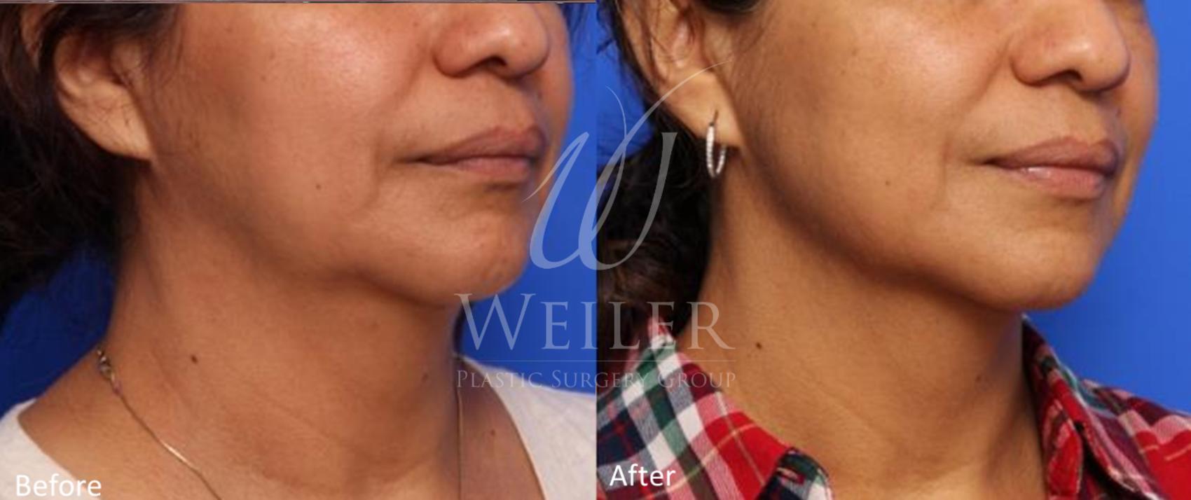 Before & After Genius® Microneedling with RF Case 400 View #1 View in Baton Rouge, New Orleans, & Lafayette, Louisiana