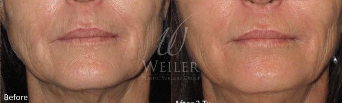 Before & After Genius® Microneedling with RF Case 401 View #1 View in Baton Rouge, New Orleans, & Lafayette, Louisiana