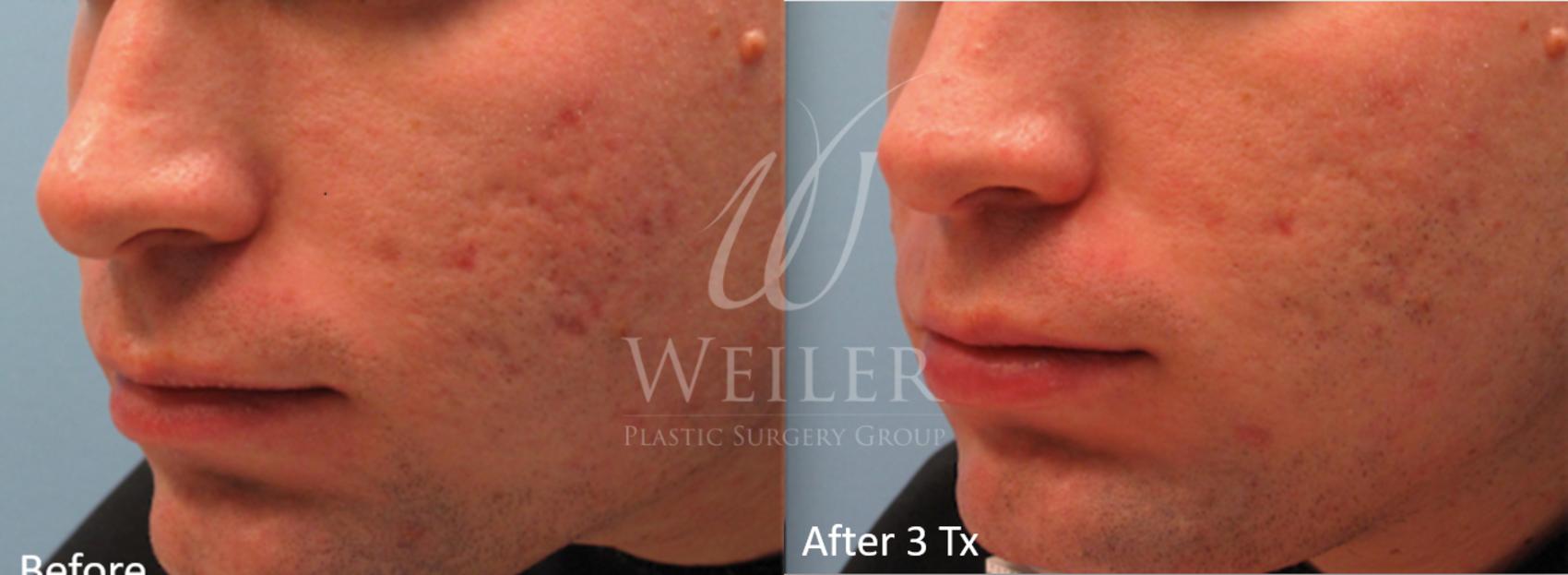 Before & After Genius® Microneedling with RF Case 403 View #1 View in Baton Rouge, Louisiana