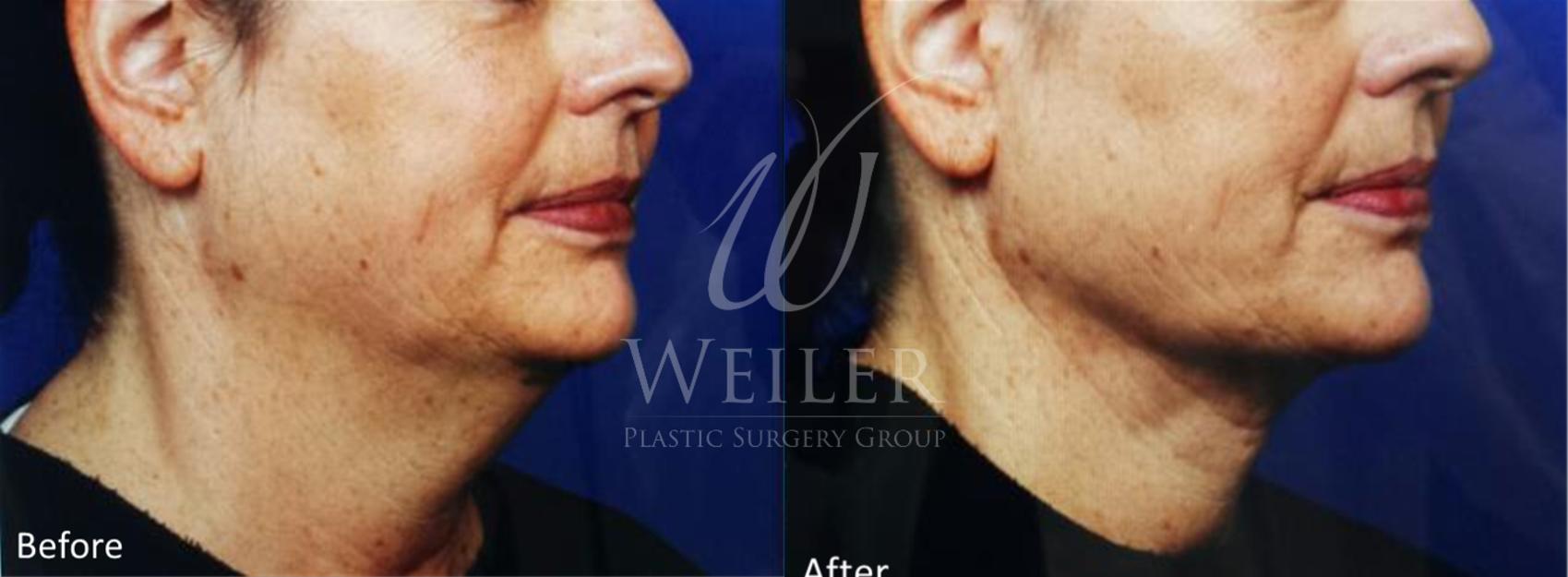 Before & After Genius® Microneedling with RF Case 404 View #1 View in Baton Rouge, Louisiana
