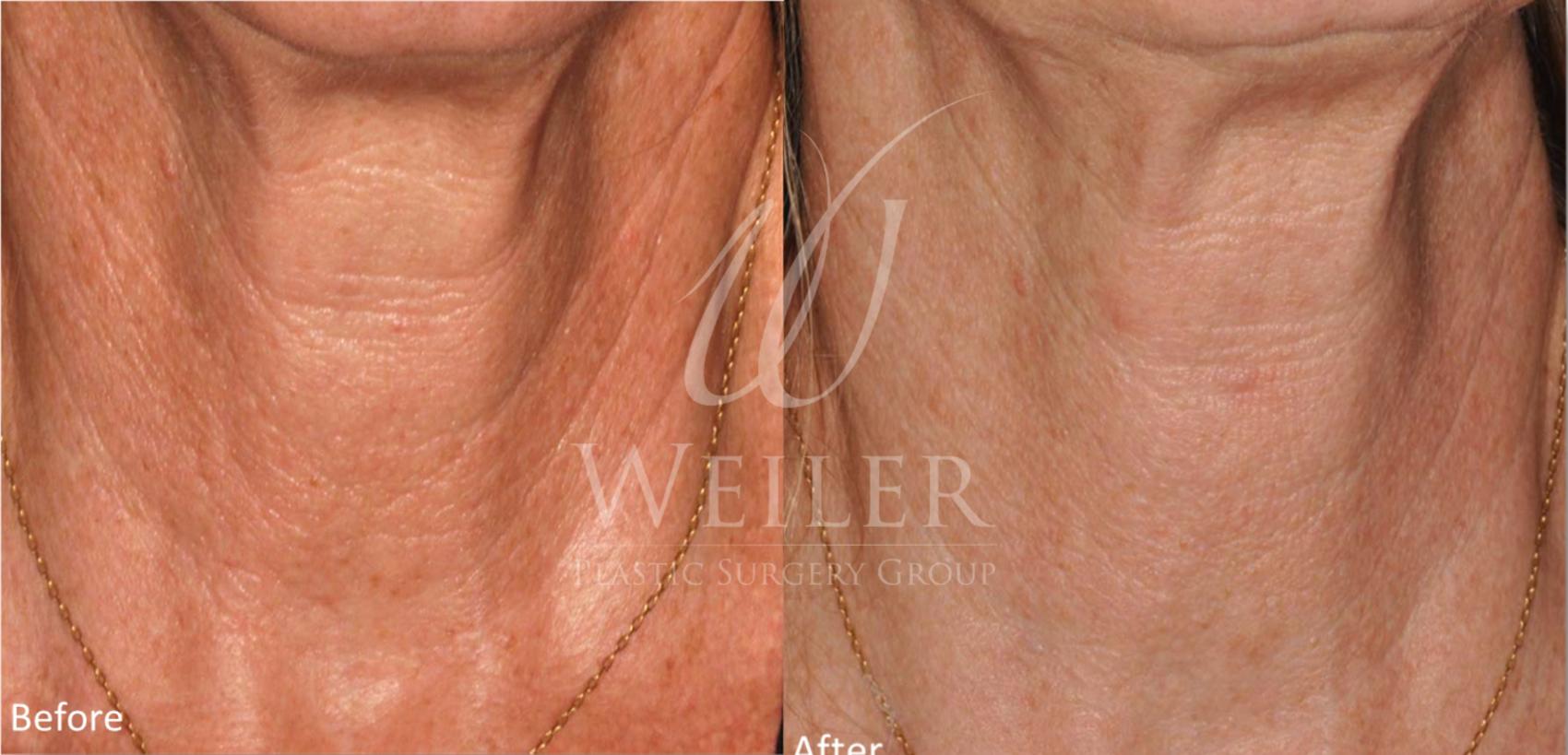 Before & After Genius® Microneedling with RF Case 405 View #1 View in Baton Rouge, New Orleans, & Lafayette, Louisiana