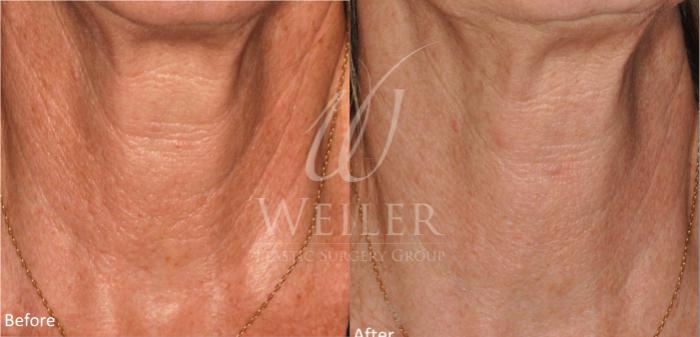 Before & After Genius® Microneedling with RF Case 405 View #1 View in Baton Rouge, Louisiana