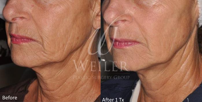 Before & After Genius® Microneedling with RF Case 406 View #1 View in Baton Rouge, Louisiana