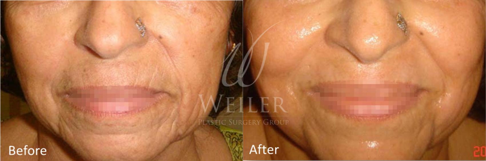 Before & After Genius® Microneedling with RF Case 407 View #1 View in Baton Rouge, Louisiana