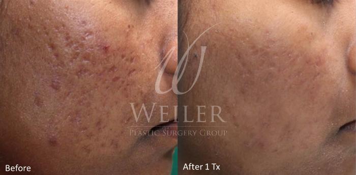 Before & After Genius® Microneedling with RF Case 410 View #1 View in Baton Rouge, Louisiana