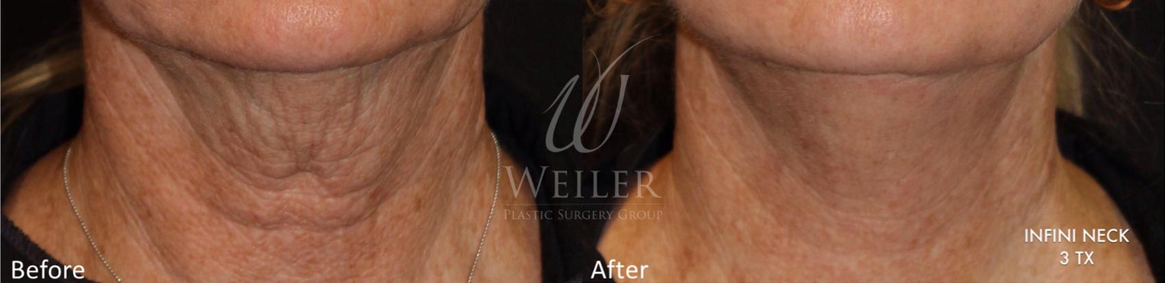 Before & After Genius® Microneedling with RF Case 411 View #1 View in Baton Rouge, Louisiana