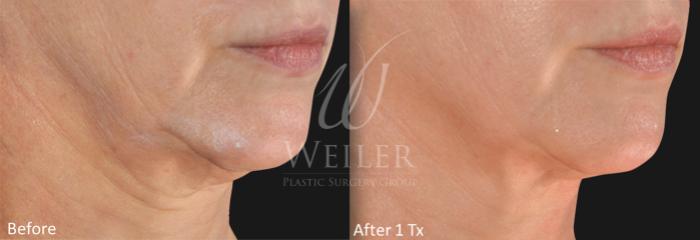 Before & After Genius® Microneedling with RF Case 412 View #1 View in Baton Rouge, New Orleans, & Lafayette, Louisiana