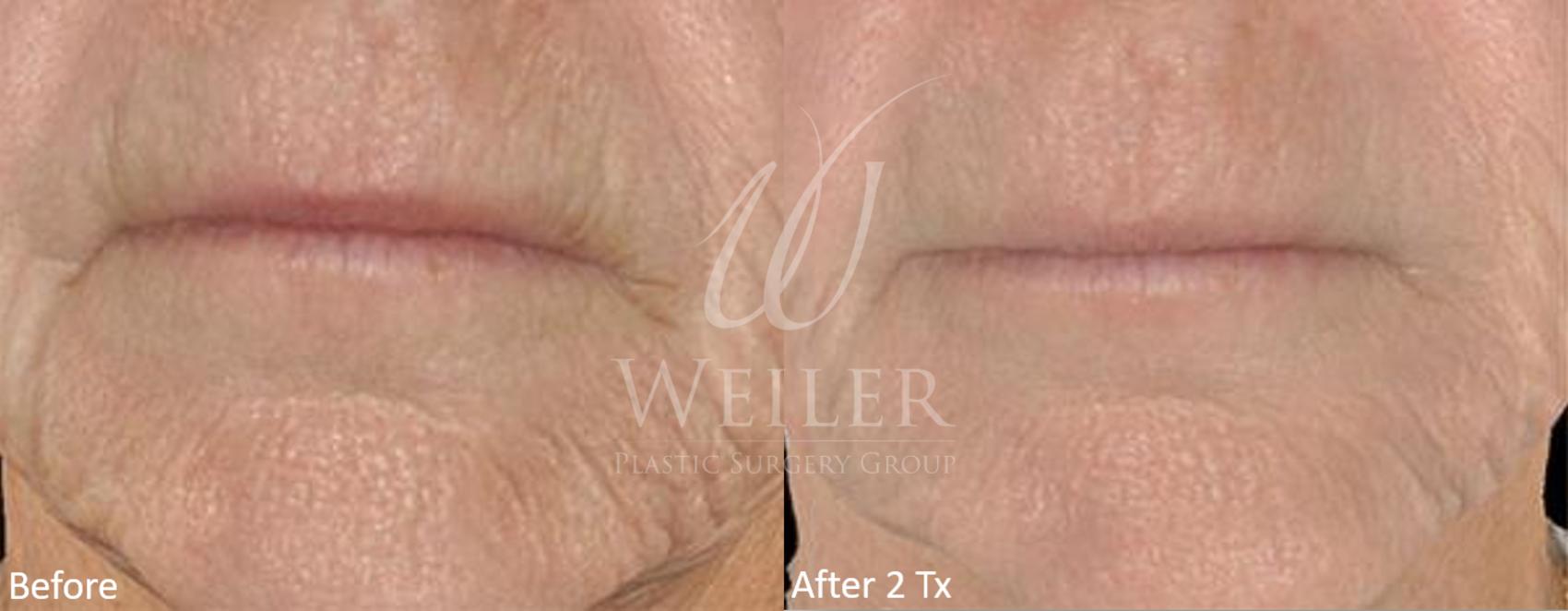 Before & After Genius® Microneedling with RF Case 413 View #1 View in Baton Rouge, Louisiana