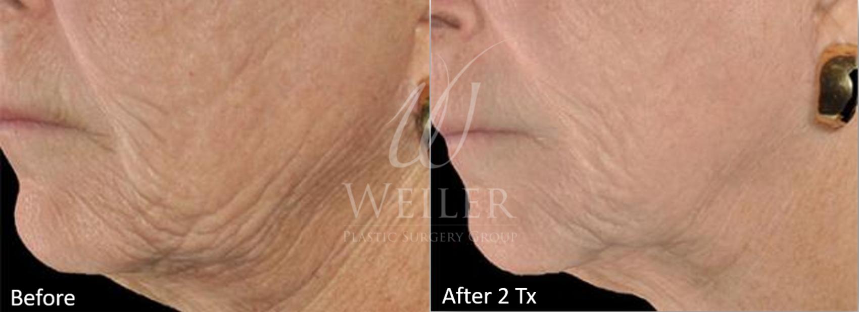 Before & After Genius® Microneedling with RF Case 414 View #1 View in Baton Rouge, Louisiana
