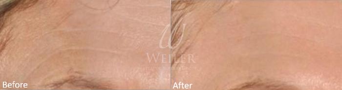 Before & After Genius® Microneedling with RF Case 415 View #1 View in Baton Rouge, Louisiana
