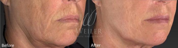 Before & After Genius® Microneedling with RF Case 416 View #1 View in Baton Rouge, New Orleans, & Lafayette, Louisiana