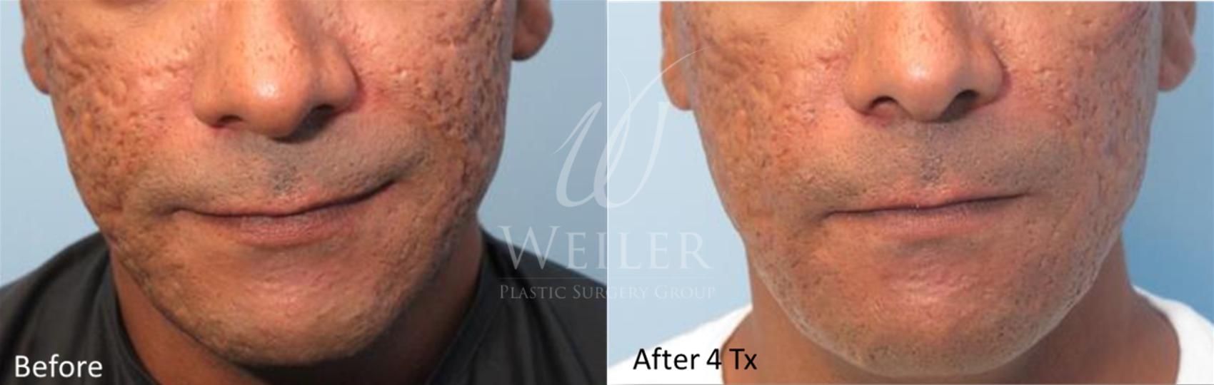 Before & After Genius® Microneedling with RF Case 417 View #1 View in Baton Rouge, New Orleans, & Lafayette, Louisiana