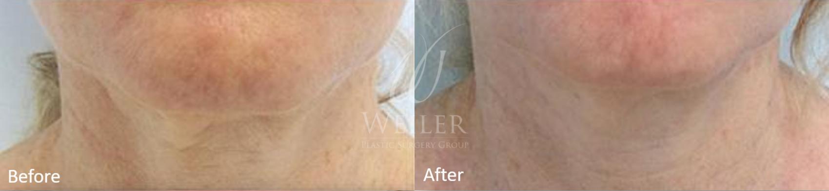 Before & After Genius® Microneedling with RF Case 418 View #1 View in Baton Rouge, New Orleans, & Lafayette, Louisiana