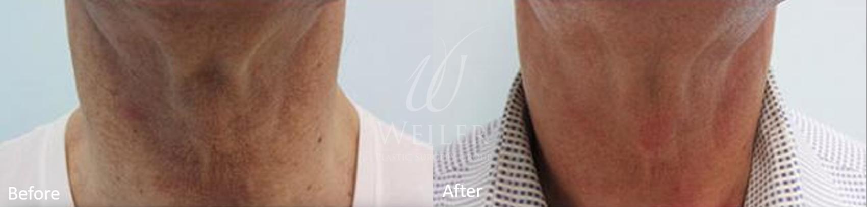 Before & After Genius® Microneedling with RF Case 419 View #1 View in Baton Rouge, Louisiana