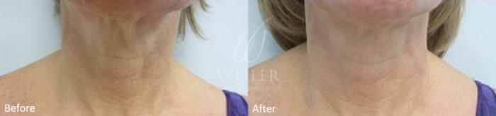 Before & After Genius® Microneedling with RF Case 420 View #1 View in Baton Rouge, Louisiana