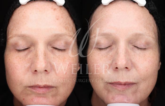 Before & After IPL Photorejuvenation Case 1706 Front View in Baton Rouge, New Orleans, & Lafayette, Louisiana