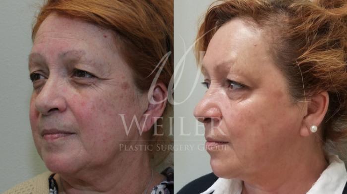 Before & After IPL Photorejuvenation Case 433 View #1 View in Baton Rouge, Louisiana