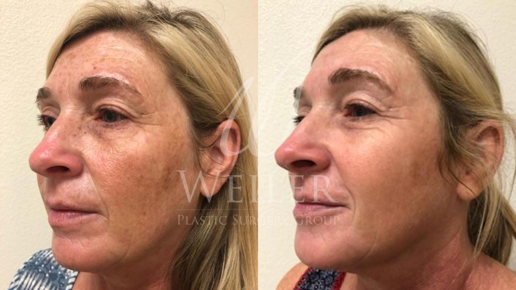 Before & After IPL Photorejuvenation Case 434 View #1 View in Baton Rouge, Louisiana