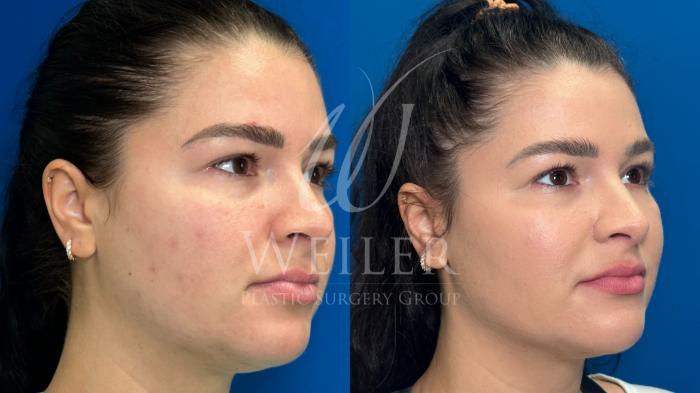 Before & After Midface Case 1149 Front View in Baton Rouge, Louisiana