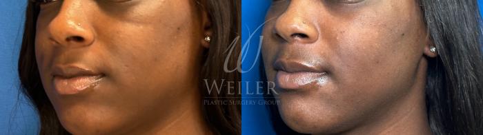 Before & After Midface Case 1182 Left Side View in Baton Rouge, Louisiana