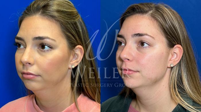 Before & After Chin Augmentation Case 1245 Left Side View in Baton Rouge, New Orleans, & Lafayette, Louisiana