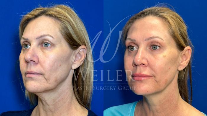 Before & After JUVÉDERM® Case 1364 Left Oblique View in Baton Rouge, New Orleans, & Lafayette, Louisiana