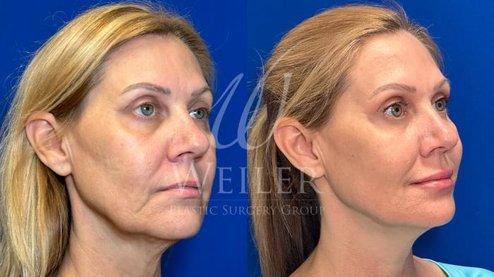 Before & After JUVÉDERM® Case 1364 Left Side View in Baton Rouge, New Orleans, & Lafayette, Louisiana