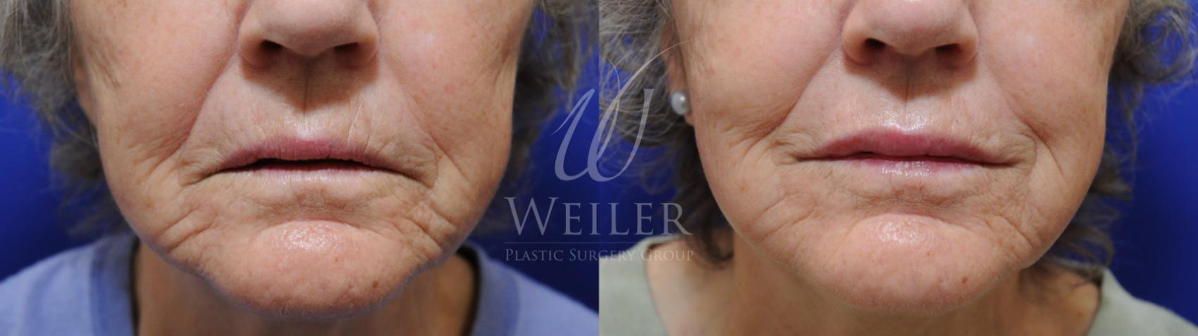 Before & After JUVÉDERM® Case 1395 Front View in Baton Rouge, New Orleans, & Lafayette, Louisiana