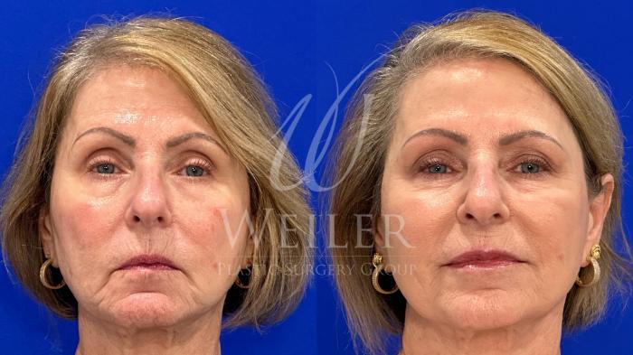 Before & After JUVÉDERM® Case 1436 Front View in Baton Rouge, New Orleans, & Lafayette, Louisiana