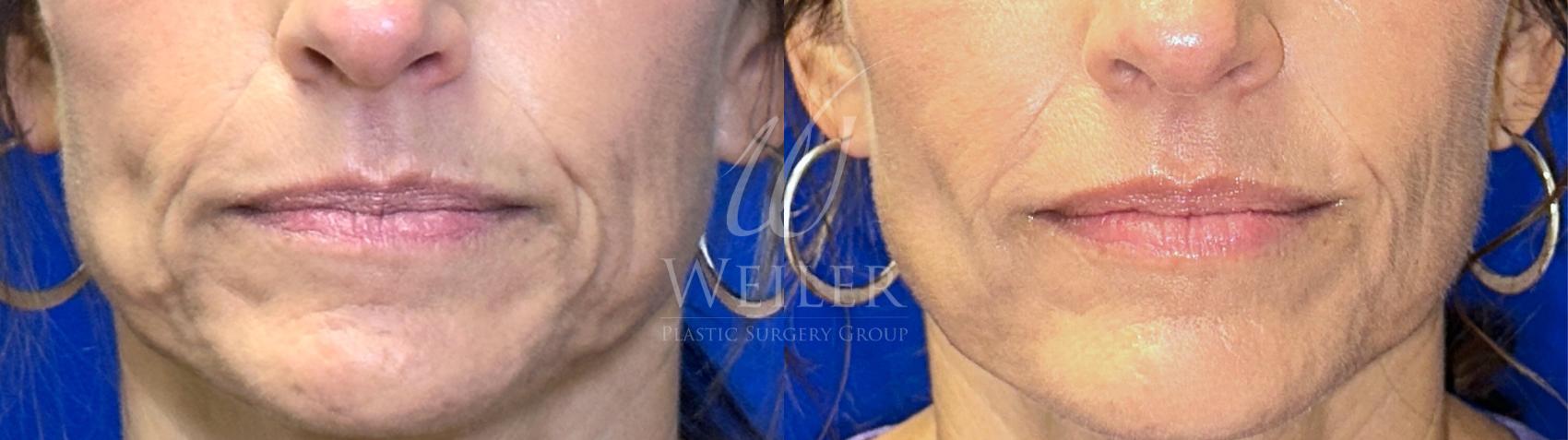 Before & After JUVÉDERM® Case 1646 Front View in Baton Rouge, New Orleans, & Lafayette, Louisiana