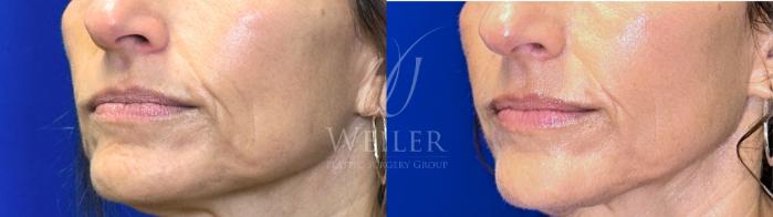 Before & After JUVÉDERM® Case 1646 Left Oblique View in Baton Rouge, New Orleans, & Lafayette, Louisiana